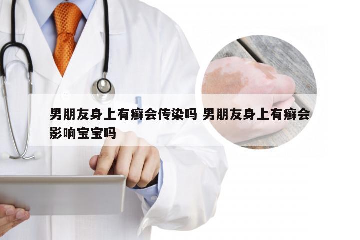 男朋友身上有癣会传染吗 男朋友身上有癣会影响宝宝吗