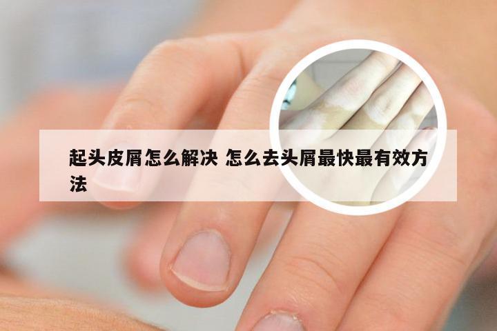 起头皮屑怎么解决 怎么去头屑最快最有效方法