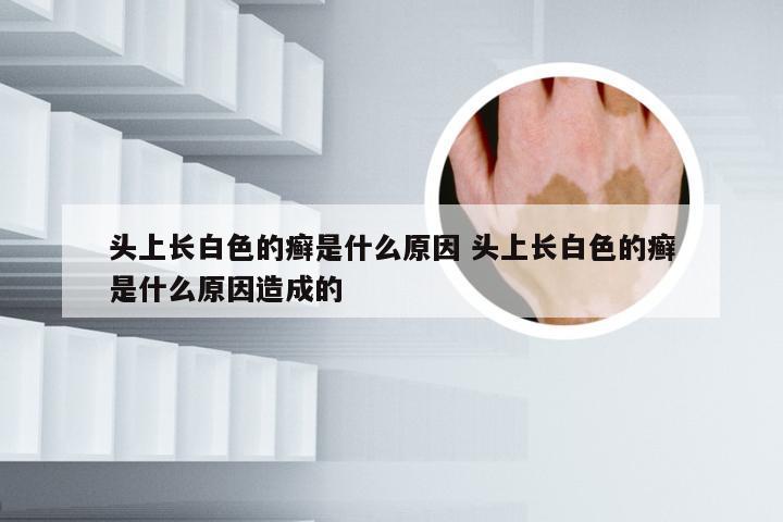 头上长白色的癣是什么原因 头上长白色的癣是什么原因造成的