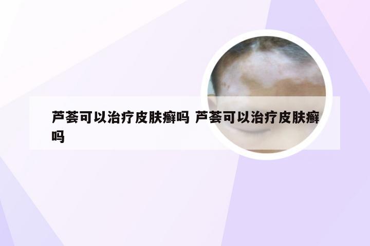 芦荟可以治疗皮肤癣吗 芦荟可以治疗皮肤癣吗