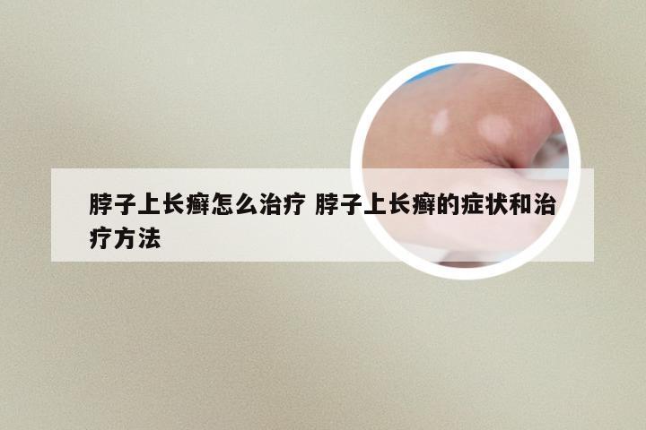 脖子上长癣怎么治疗 脖子上长癣的症状和治疗方法