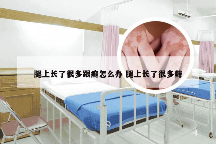 腿上长了很多跟癣怎么办 腿上长了很多藓