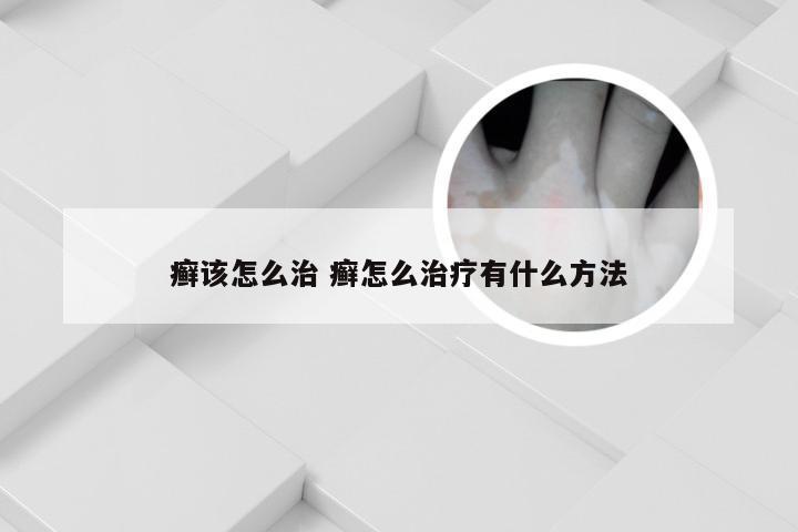 癣该怎么治 癣怎么治疗有什么方法