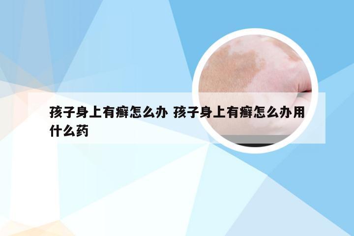 孩子身上有癣怎么办 孩子身上有癣怎么办用什么药