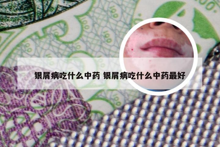 银屑病吃什么中药 银屑病吃什么中药最好