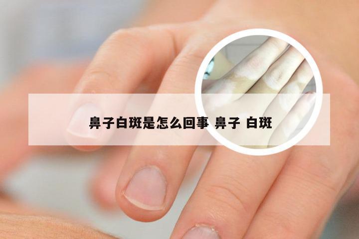 鼻子白斑是怎么回事 鼻子 白斑