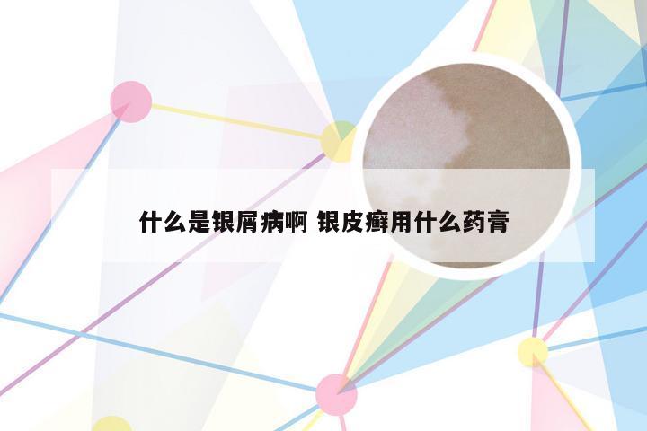 什么是银屑病啊 银皮癣用什么药膏