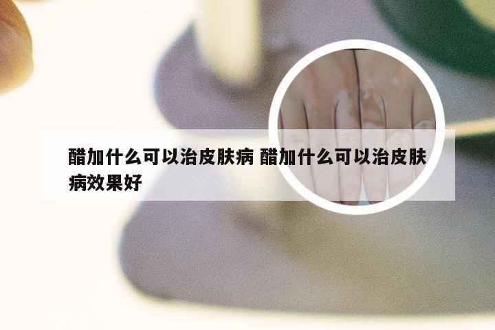 醋加什么可以治皮肤病 醋加什么可以治皮肤病效果好