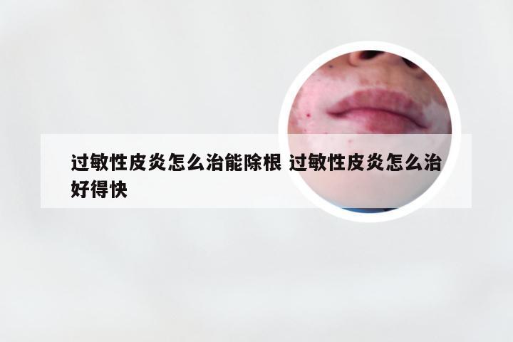 过敏性皮炎怎么治能除根 过敏性皮炎怎么治好得快