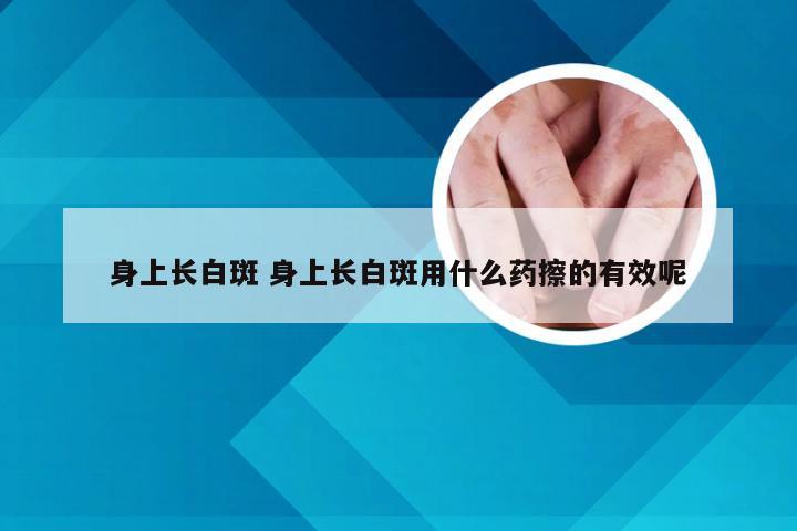 身上长白斑 身上长白斑用什么药擦的有效呢