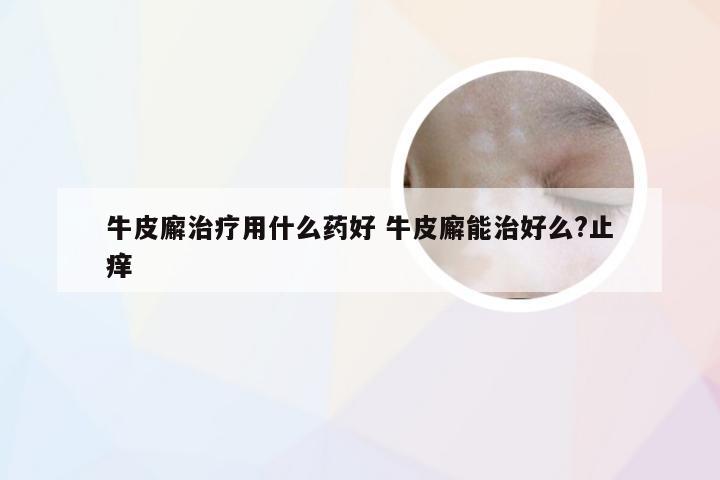 牛皮廨治疗用什么药好 牛皮廨能治好么?止痒