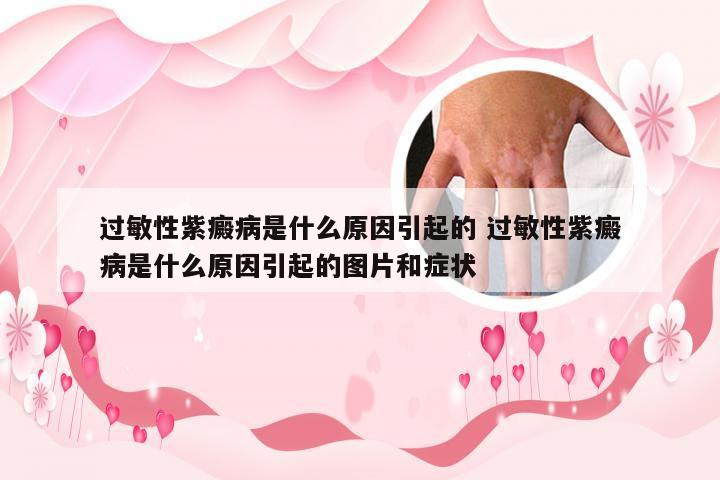 过敏性紫癜病是什么原因引起的 过敏性紫癜病是什么原因引起的图片和症状