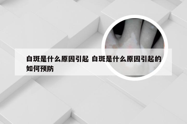 白斑是什么原因引起 白斑是什么原因引起的如何预防