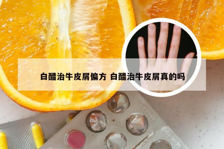 白醋治牛皮屑偏方 白醋治牛皮屑真的吗