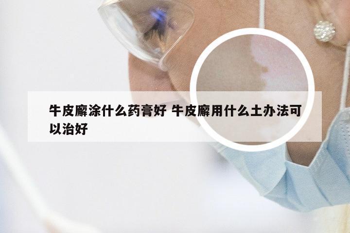 牛皮廨涂什么药膏好 牛皮廨用什么土办法可以治好