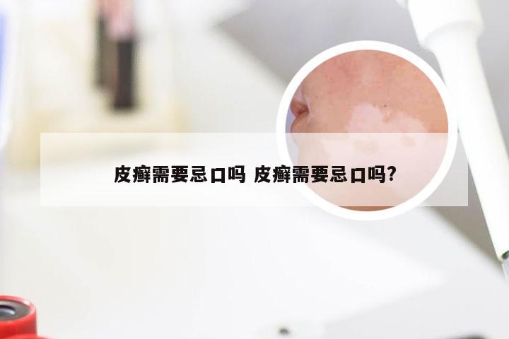 皮癣需要忌口吗 皮癣需要忌口吗?