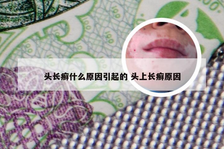 头长癣什么原因引起的 头上长癣原因