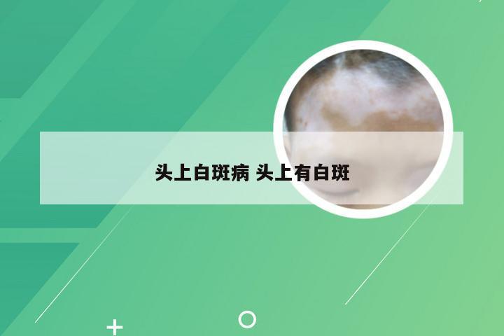 头上白斑病 头上有白斑