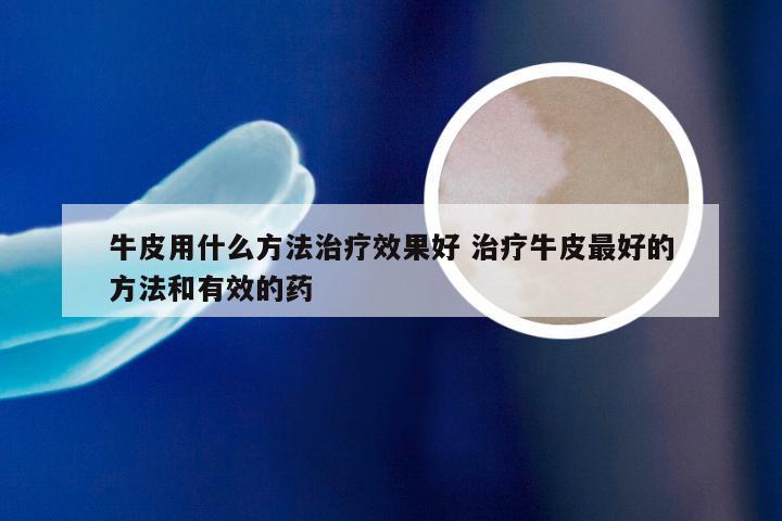 牛皮用什么方法治疗效果好 治疗牛皮最好的方法和有效的药