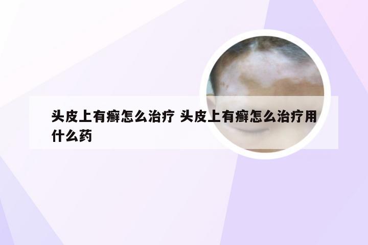 头皮上有癣怎么治疗 头皮上有癣怎么治疗用什么药