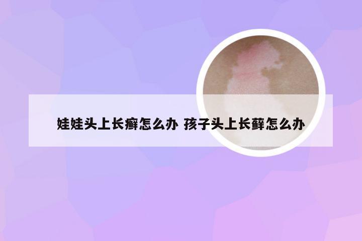 娃娃头上长癣怎么办 孩子头上长藓怎么办