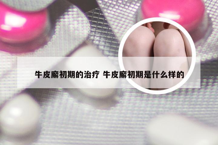 牛皮廨初期的治疗 牛皮廨初期是什么样的