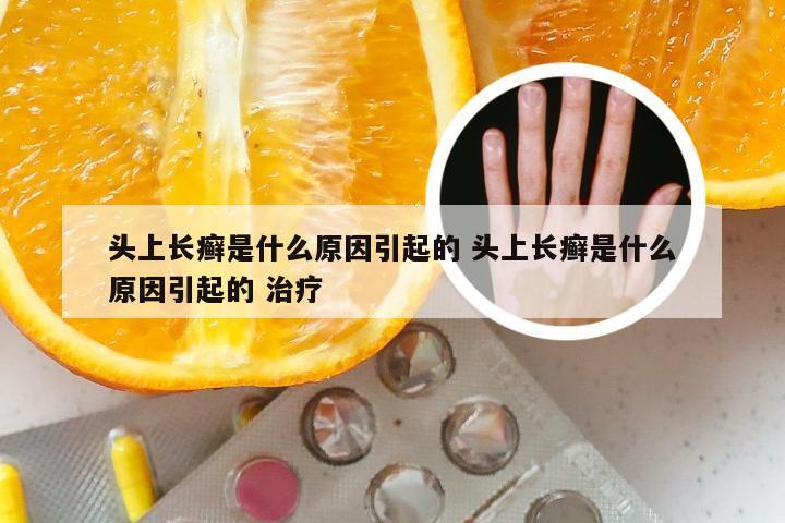 头上长癣是什么原因引起的 头上长癣是什么原因引起的 治疗