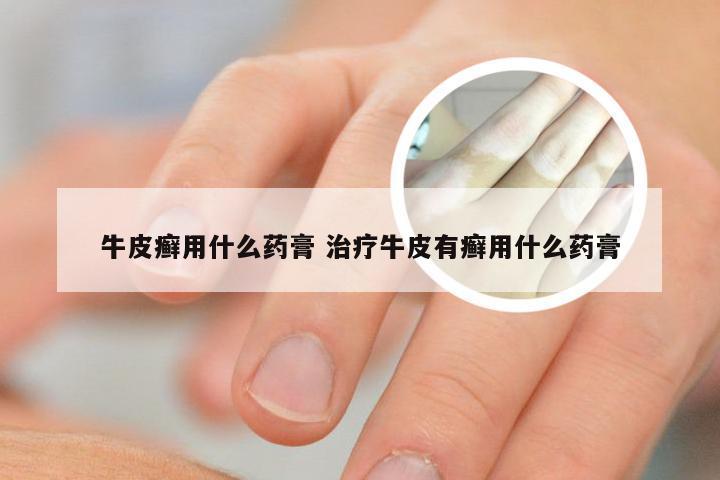 牛皮癣用什么药膏 治疗牛皮有癣用什么药膏