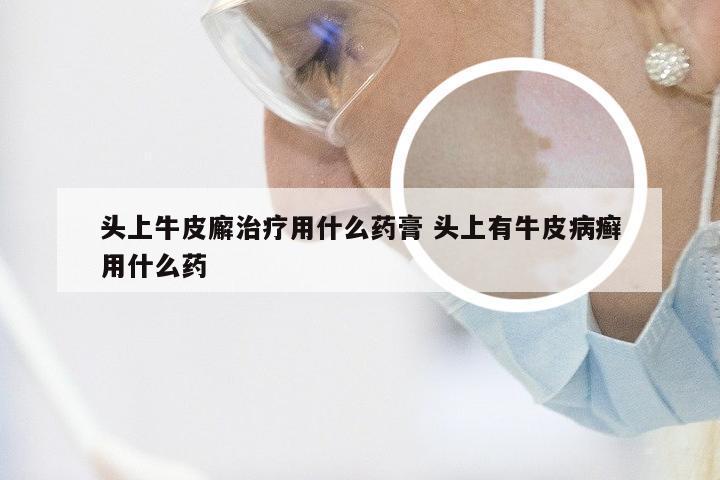 头上牛皮廨治疗用什么药膏 头上有牛皮病癣用什么药