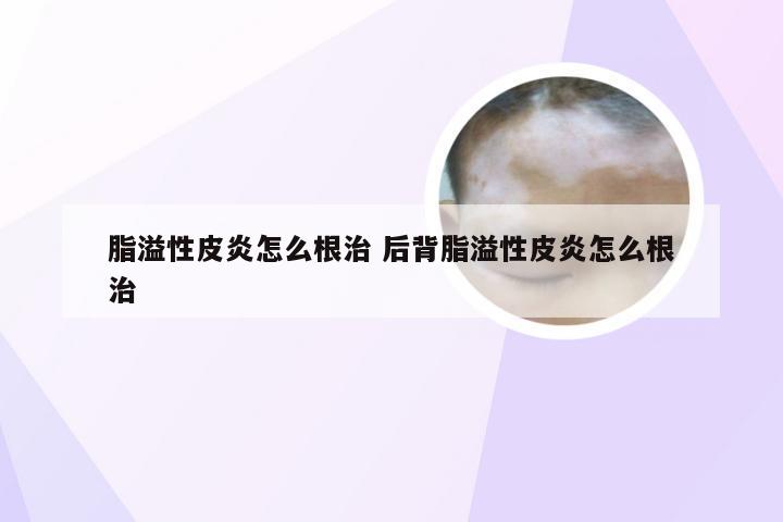 脂溢性皮炎怎么根治 后背脂溢性皮炎怎么根治