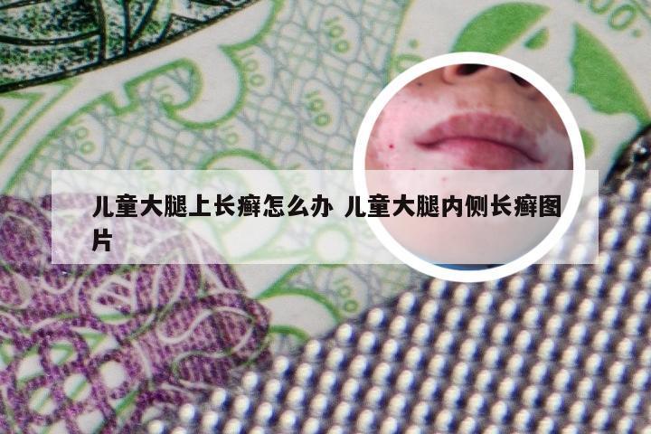 儿童大腿上长癣怎么办 儿童大腿内侧长癣图片