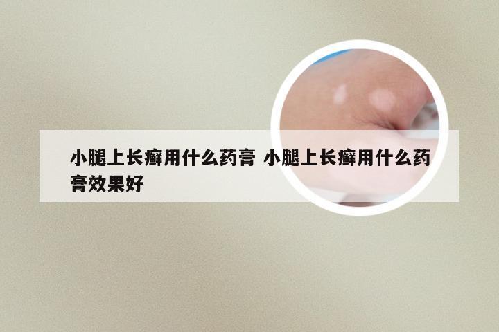 小腿上长癣用什么药膏 小腿上长癣用什么药膏效果好