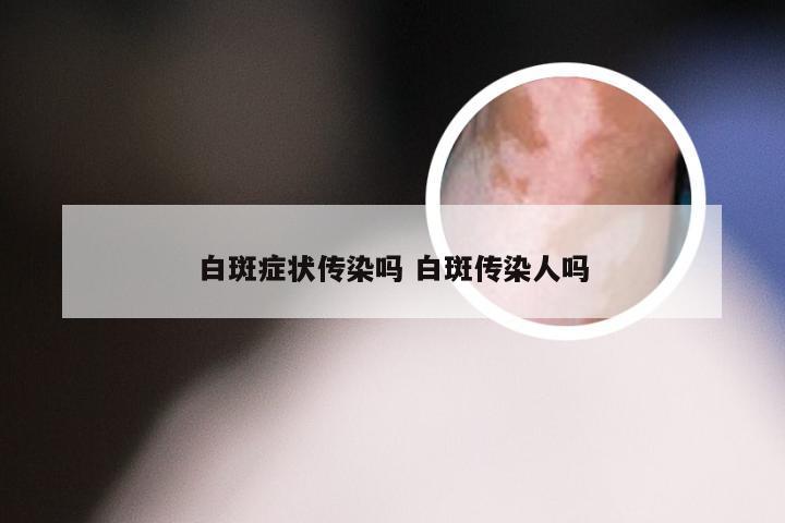 白斑症状传染吗 白斑传染人吗