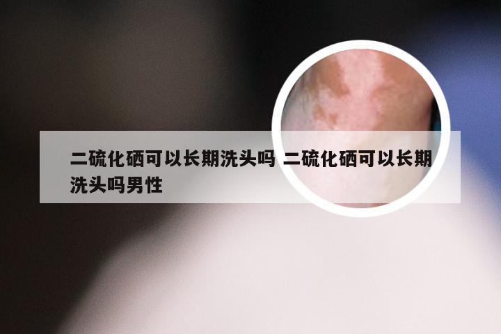 二硫化硒可以长期洗头吗 二硫化硒可以长期洗头吗男性