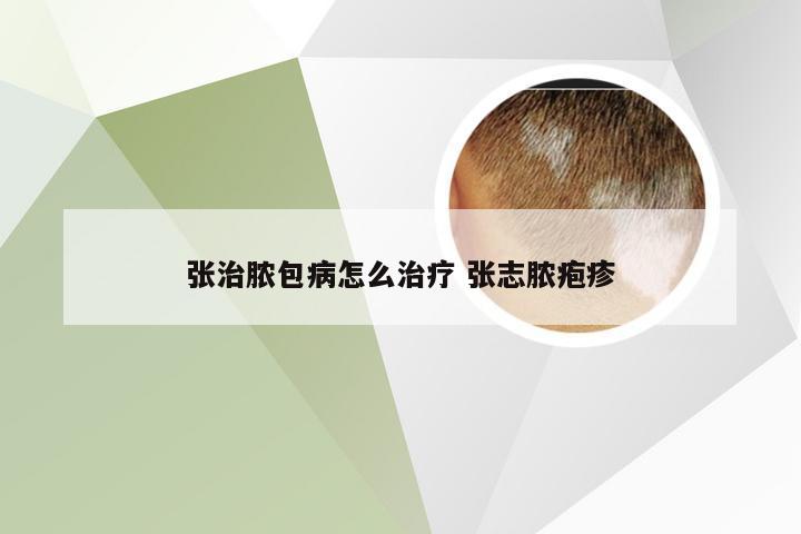 张治脓包病怎么治疗 张志脓疱疹