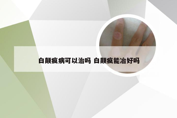 白颠疯病可以治吗 白颠疯能冶好吗