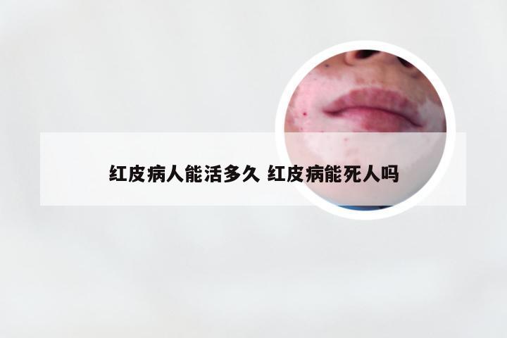 红皮病人能活多久 红皮病能死人吗