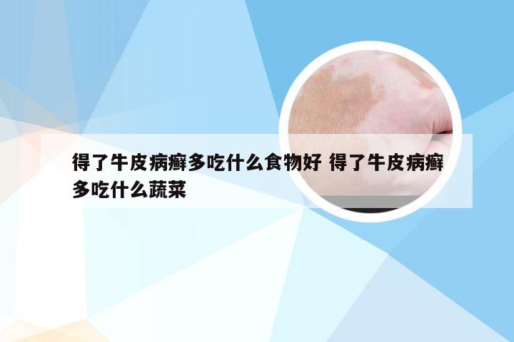 得了牛皮病癣多吃什么食物好 得了牛皮病癣多吃什么蔬菜