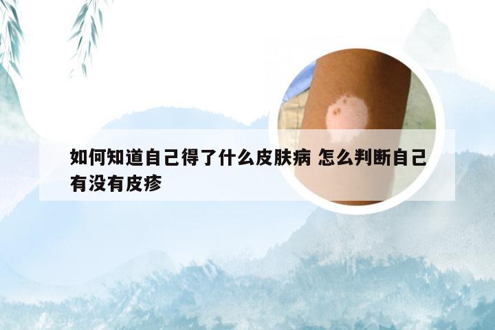 如何知道自己得了什么皮肤病 怎么判断自己有没有皮疹