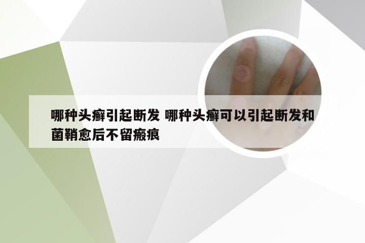 哪种头癣引起断发 哪种头癣可以引起断发和菌鞘愈后不留瘢痕