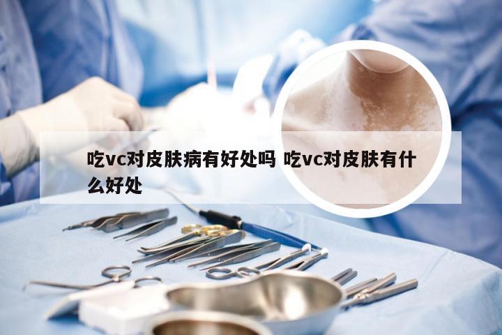 吃vc对皮肤病有好处吗 吃vc对皮肤有什么好处