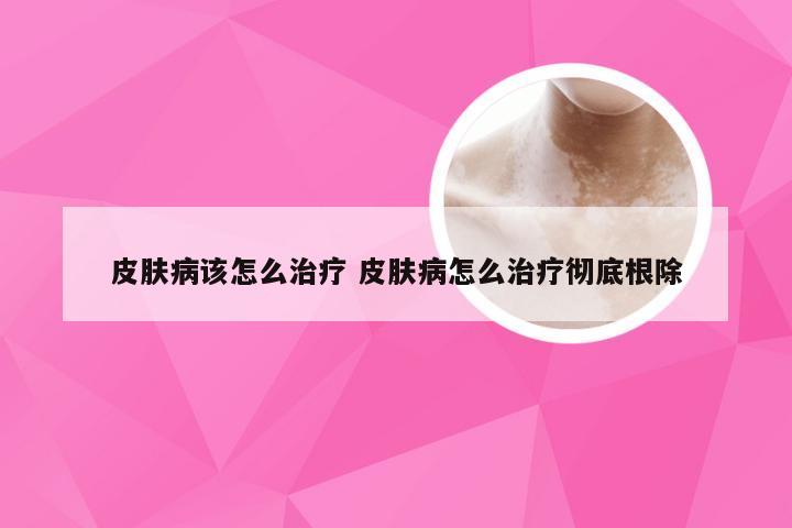 皮肤病该怎么治疗 皮肤病怎么治疗彻底根除