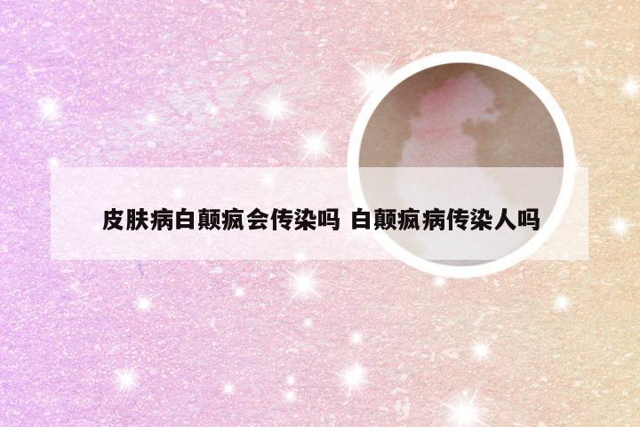 皮肤病白颠疯会传染吗 白颠疯病传染人吗