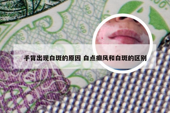 手背出现白斑的原因 白点癫风和白斑的区别