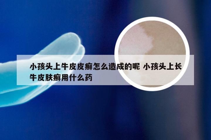 小孩头上牛皮皮癣怎么造成的呢 小孩头上长牛皮肤癣用什么药