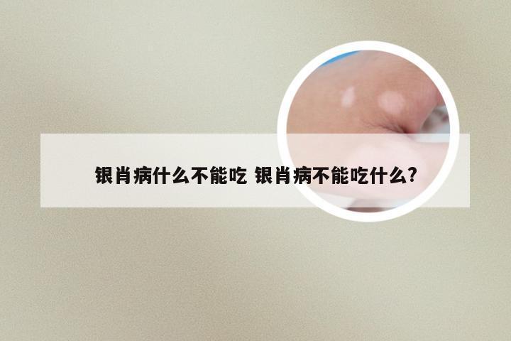 银肖病什么不能吃 银肖病不能吃什么?