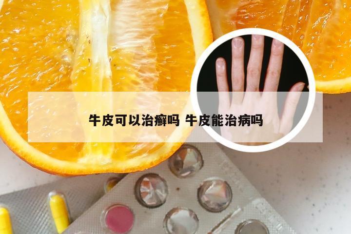 牛皮可以治癣吗 牛皮能治病吗