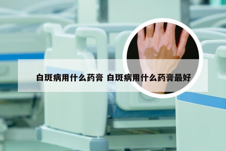 白斑病用什么药膏 白斑病用什么药膏最好