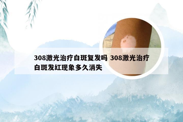 308激光治疗白斑复发吗 308激光治疗白斑发红现象多久消失