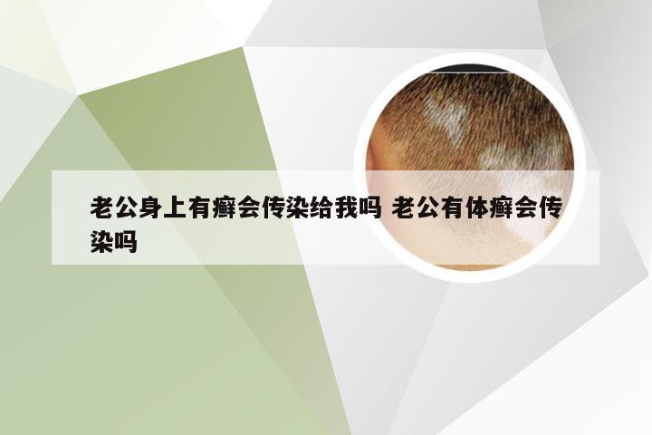 老公身上有癣会传染给我吗 老公有体癣会传染吗